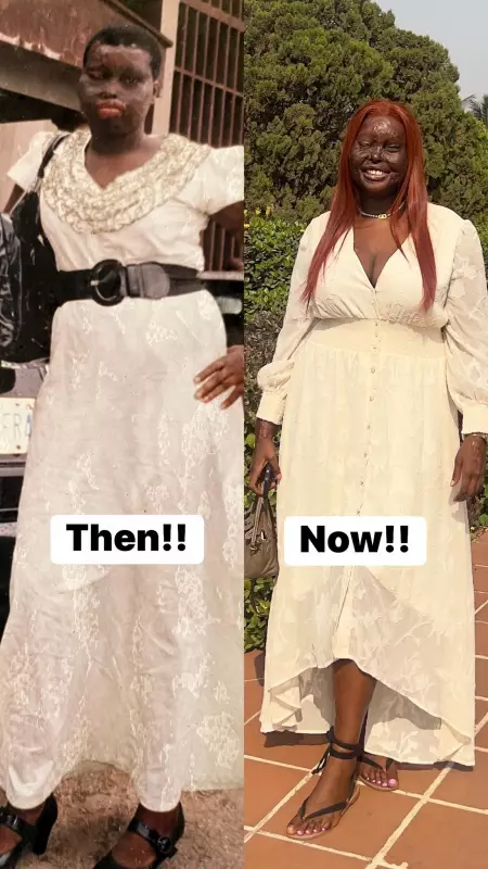 From Flames to Fame: Nigerian Burn Survivor's Incredible Transformation Will Leave You Speechless