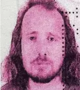 36-Year-Old British Man Dies After Hair Transplant in Turkey