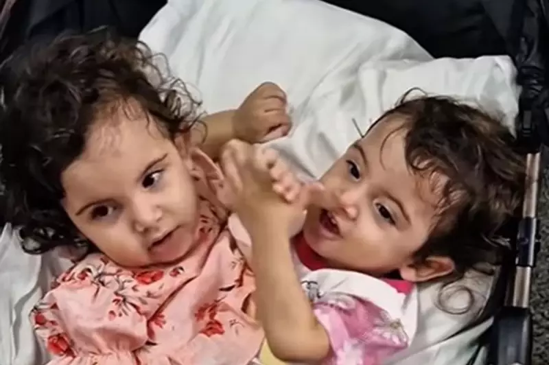 Conjoined Twin Aruna Dies Months After 19-Hour Separation Surgery in Brazil