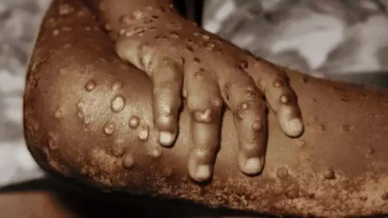 Nigeria Records 414 Mpox Cases, 6 Deaths Across 33 States in 2025