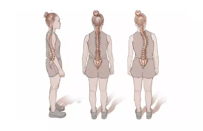 Scoliosis Focus Foundation Marks 12 Years, Calls for National Support