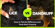 Lice vs Dandruff in Nigeria: Spot the Difference and Get the Right Treatment