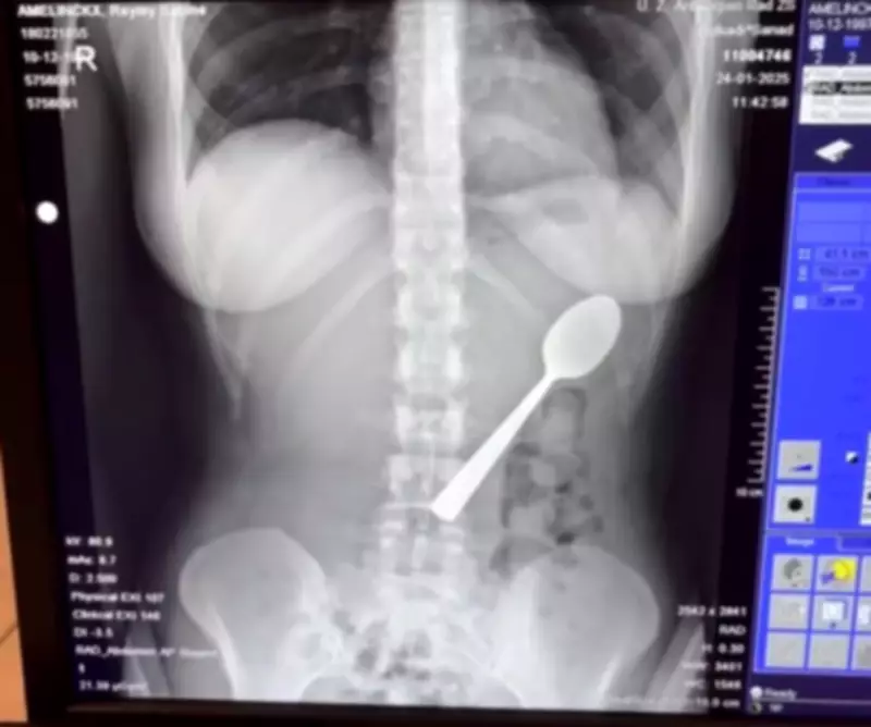 Belgian Woman Accidentally Swallows 17cm Spoon After Dog Startles Her