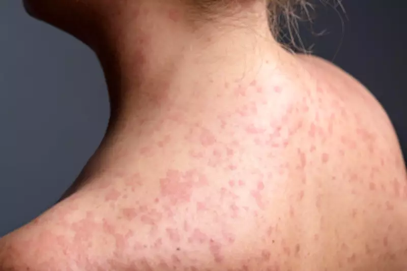 UK Measles Outbreak Forces Unvaccinated Children into 21-Day School Exclusion