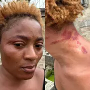 Woman Vows Never to Marry Again After Revealing Injuries Sustained During Marriage