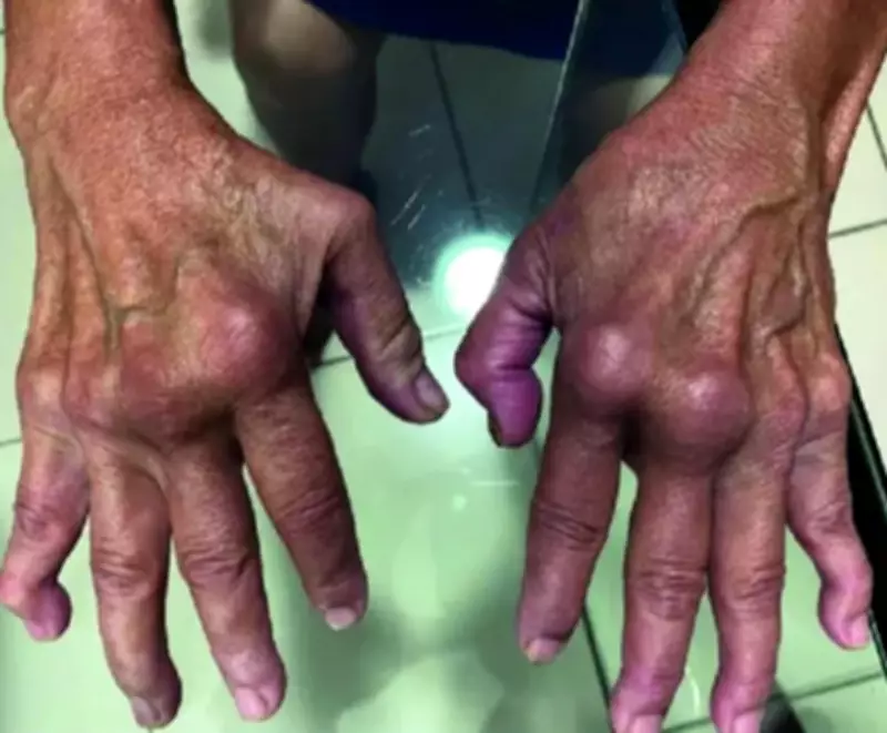 UK Reports 43% Surge in Chikungunya Cases, Warns of Mosquito-Borne Virus Spread