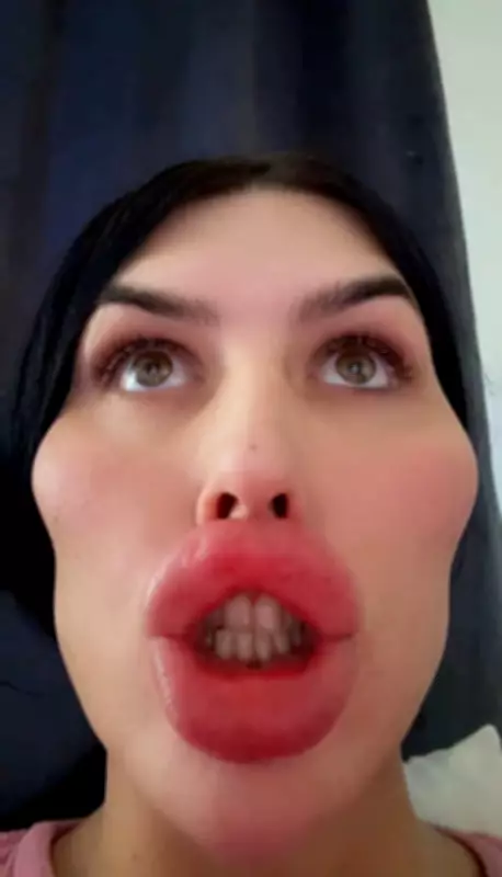 UK's 'Biggest Lips' Model Dissolves Fillers, Reveals Natural Face After Decade