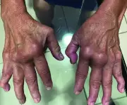 UK Reports 43% Surge in Chikungunya Cases, Warns of Mosquito-Borne Virus Spread