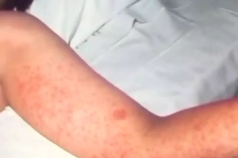 California Measles Outbreak Grows to 34 Cases, Health Officials Urge Vaccination
