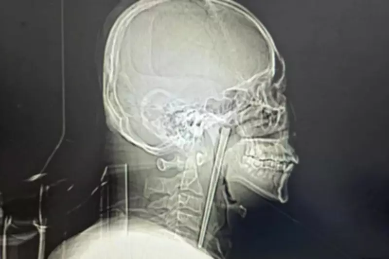 Man Lives 8 Years with Metal Chopstick in Throat, Finally Removed
