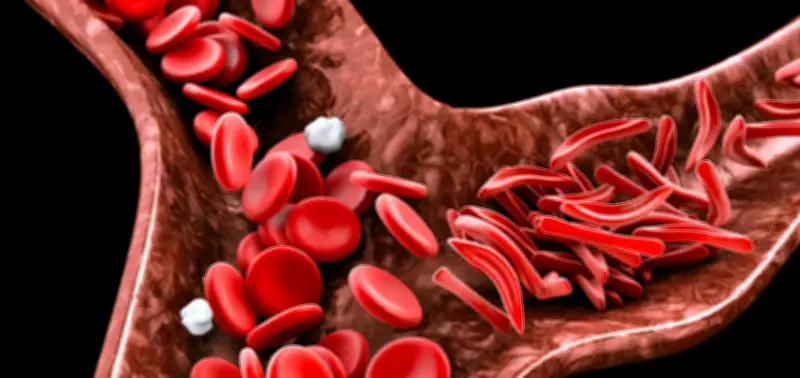 Nigeria Leads World in Child Sickle Cell Cases, Study Reveals Urgent Health Crisis