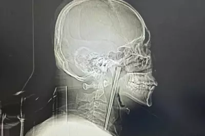 Man Lives 8 Years with Metal Chopstick in Throat, Finally Removed