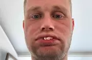 UK Dad's Dental Disaster: Turkey Teeth Surgery Leaves Him Toothless