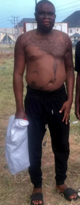 Nigerian Man Pours Acid on His Elder Brother in Shocking Attack