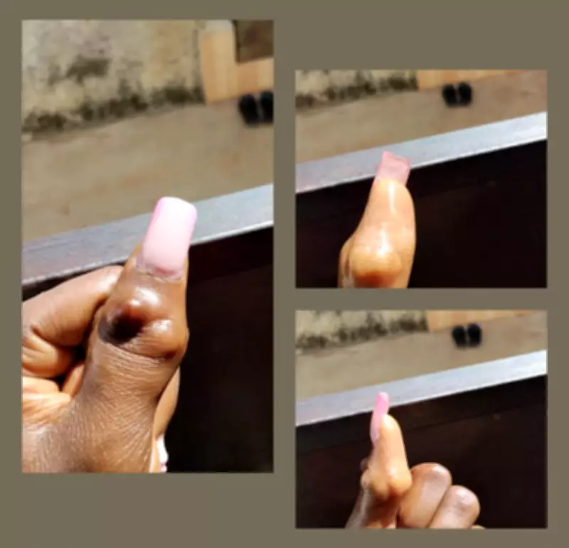 Woman Shares How High School Bullying Disfigured Her Thumb