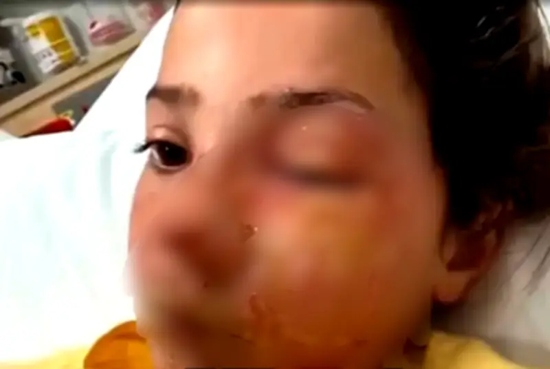 10-Year-Old Girl Suffers Facial Burns From Microwaved Squishy Toy Trend