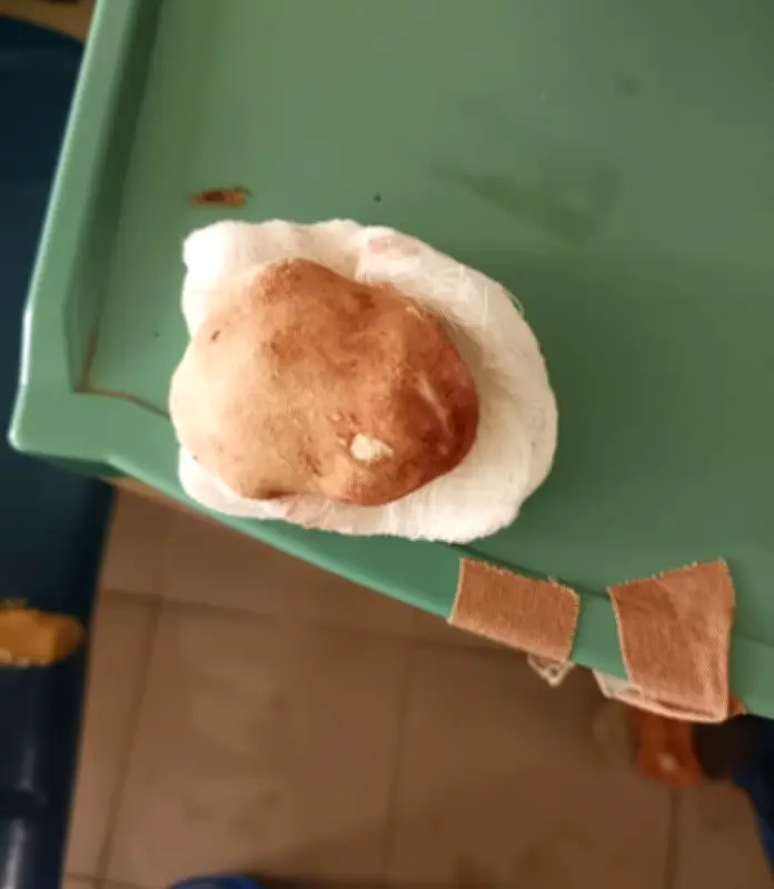 Doctor Warns: Boy's Bladder Stone Shows Dangers of Not Drinking Water
