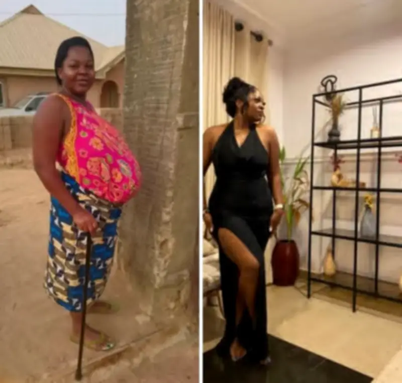 Nigerian woman’s remarkable transformation after Bell’s palsy, hypertension